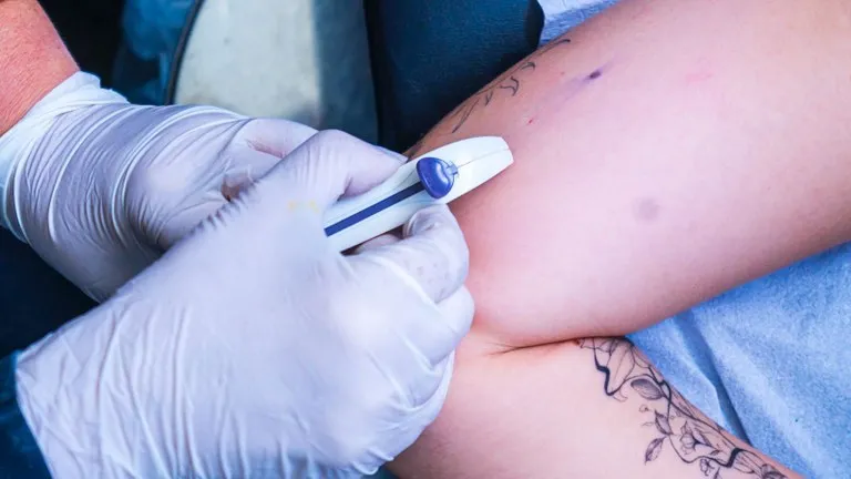 Governo da Paraíba vai ofertar contraceptivo subdérmico e capacita profissionais da Atenção Básica